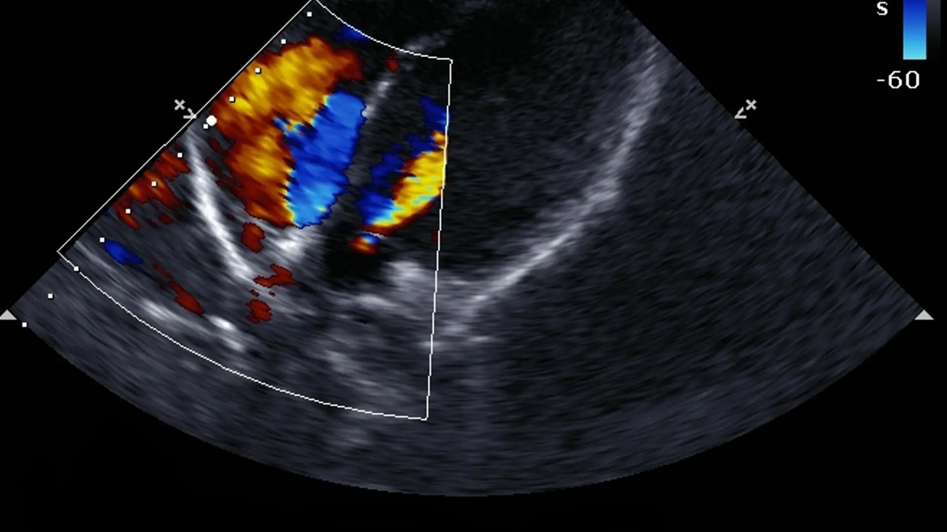 Ultrassom Doppler vascular